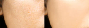 Perfect skin