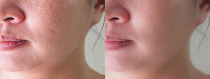 Perfect skin